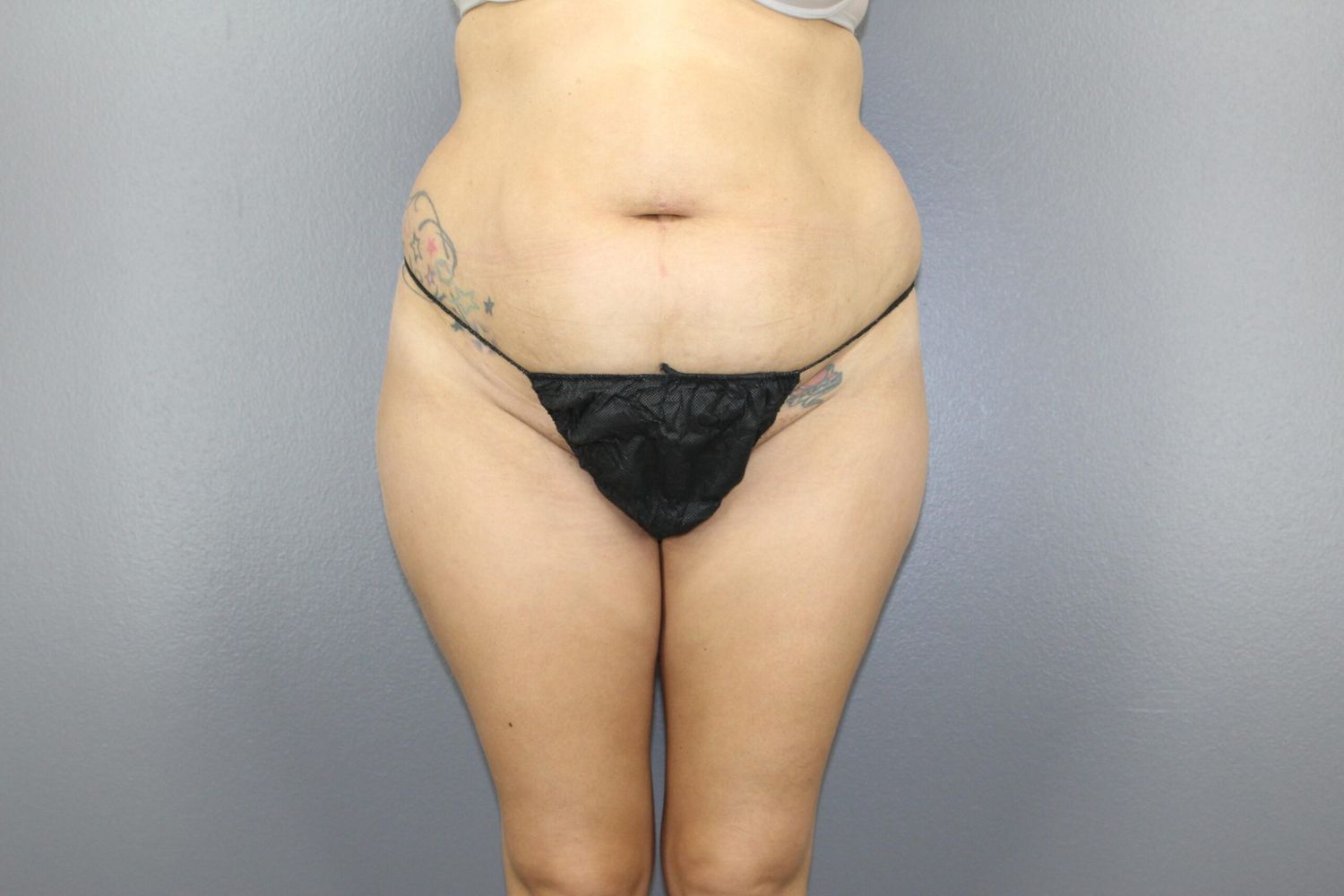 Liposuction Before & After