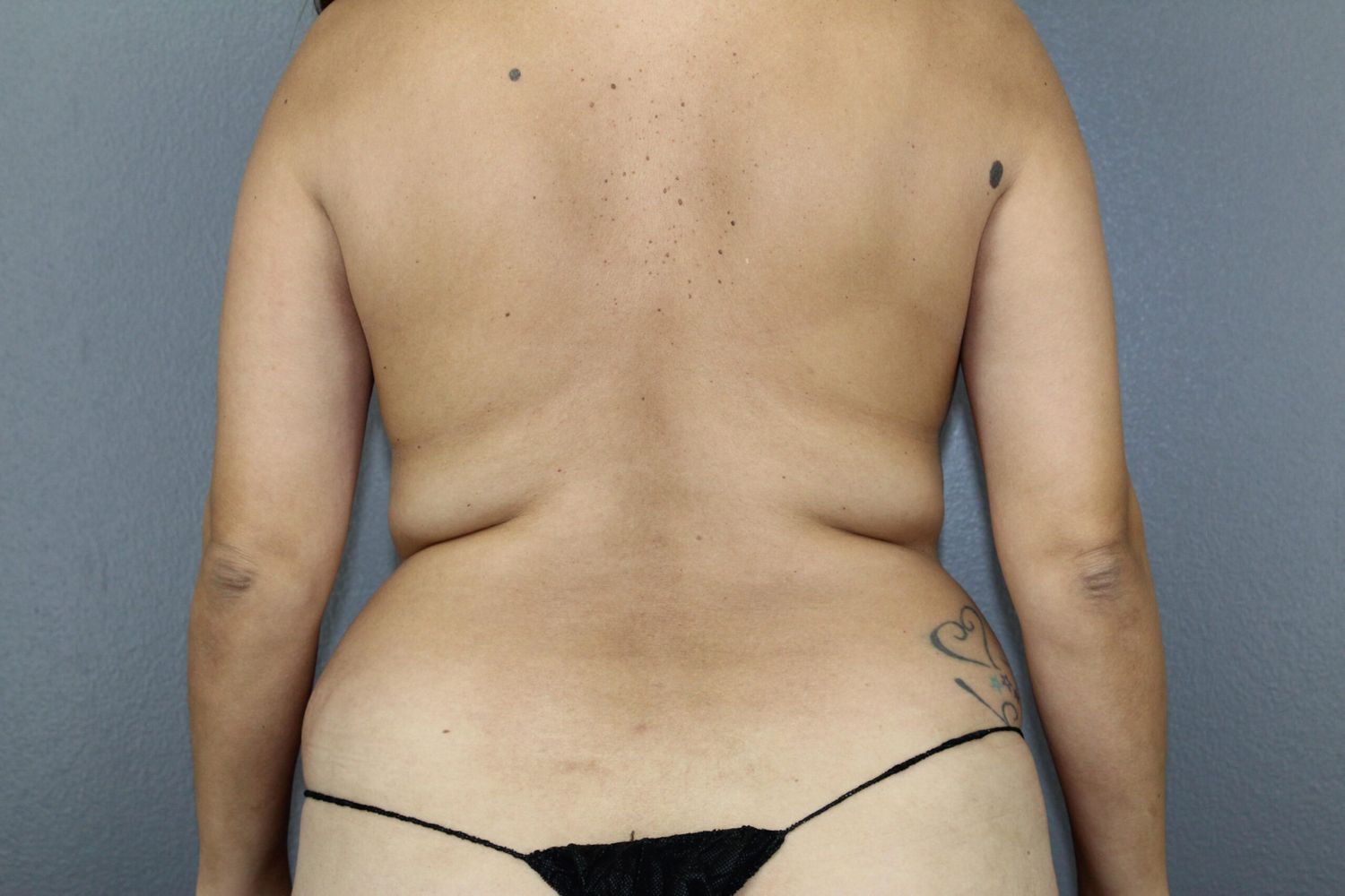 Liposuction Before & After