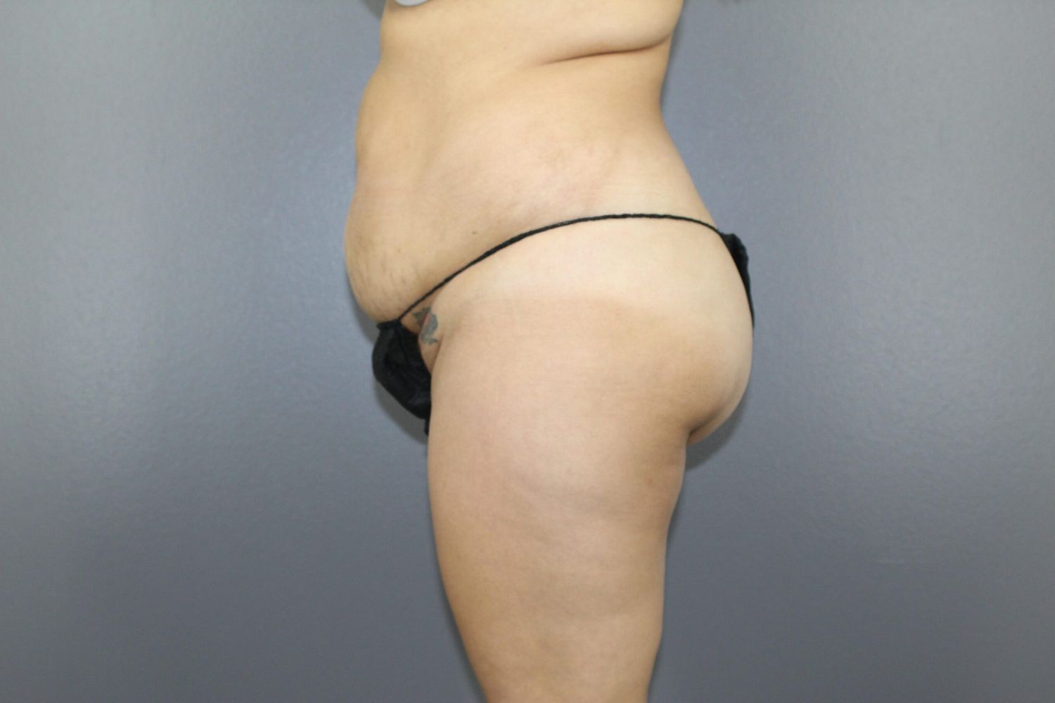 Liposuction Before & After