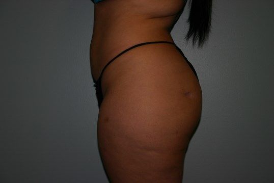 Liposuction Before & After