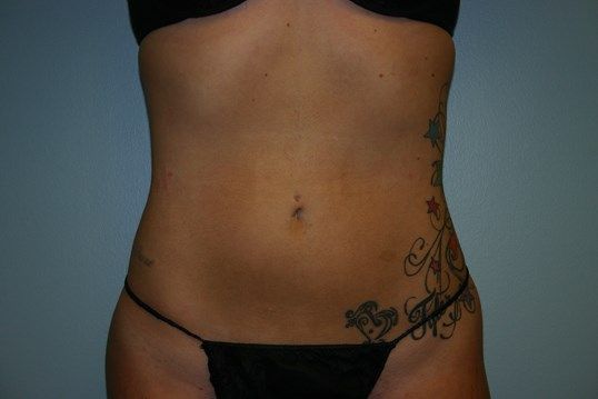 Liposuction Before & After