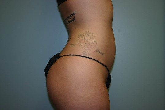 Liposuction Before & After