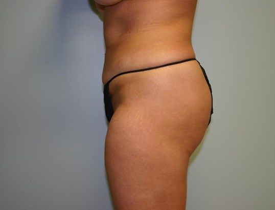 Liposuction Before & After