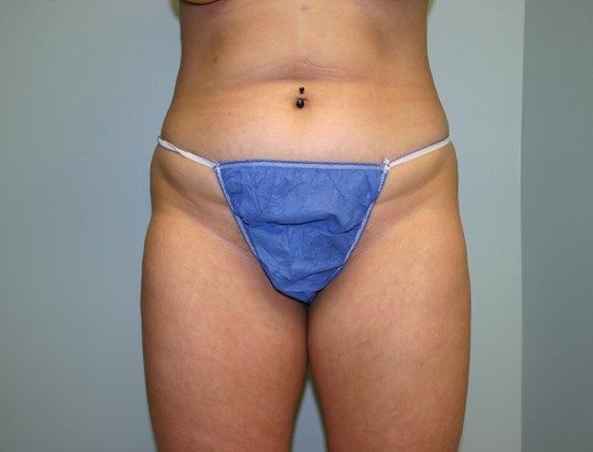 Liposuction Before & After