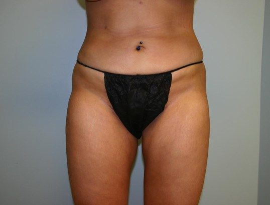 Liposuction Before & After