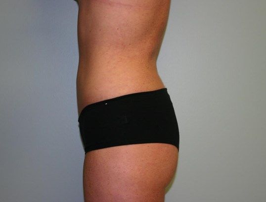 Liposuction Before & After