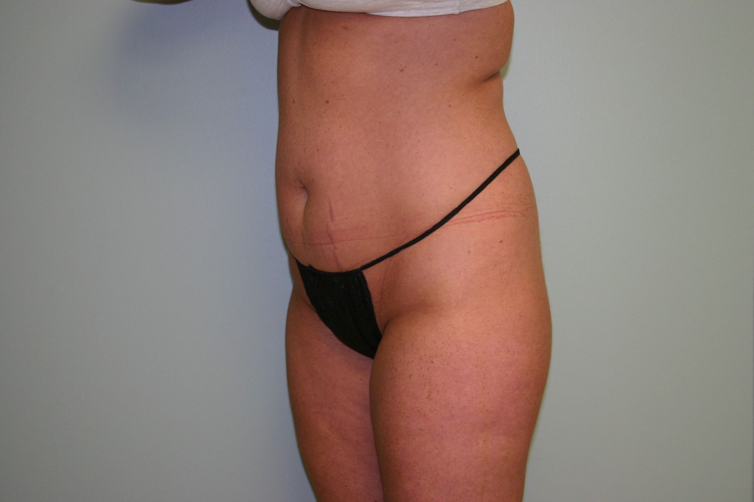 Liposuction Before & After