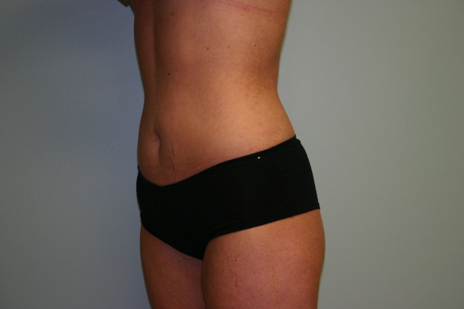 Liposuction Before & After