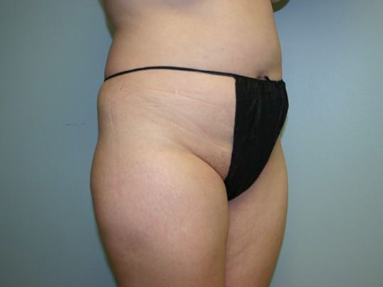 Liposuction Before & After