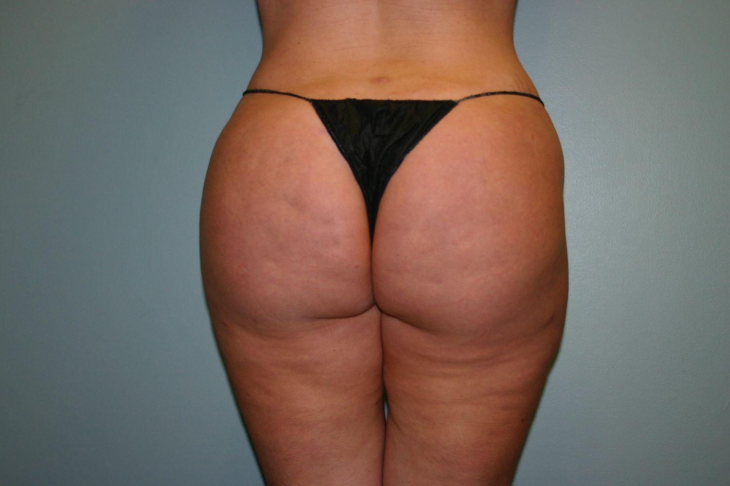 Liposuction Before & After