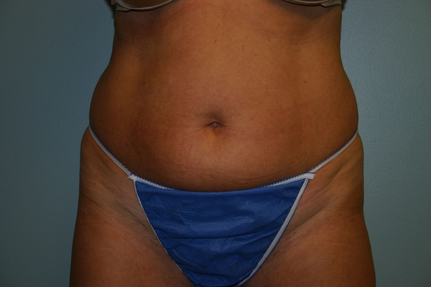 Liposuction Before & After