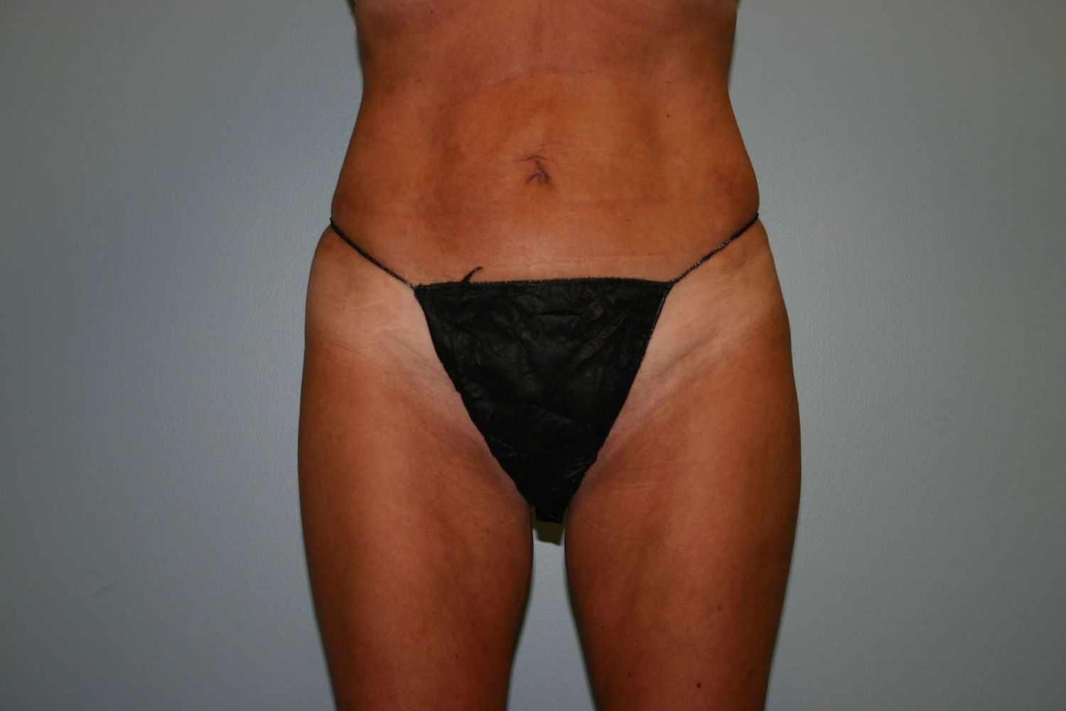 Liposuction Before & After
