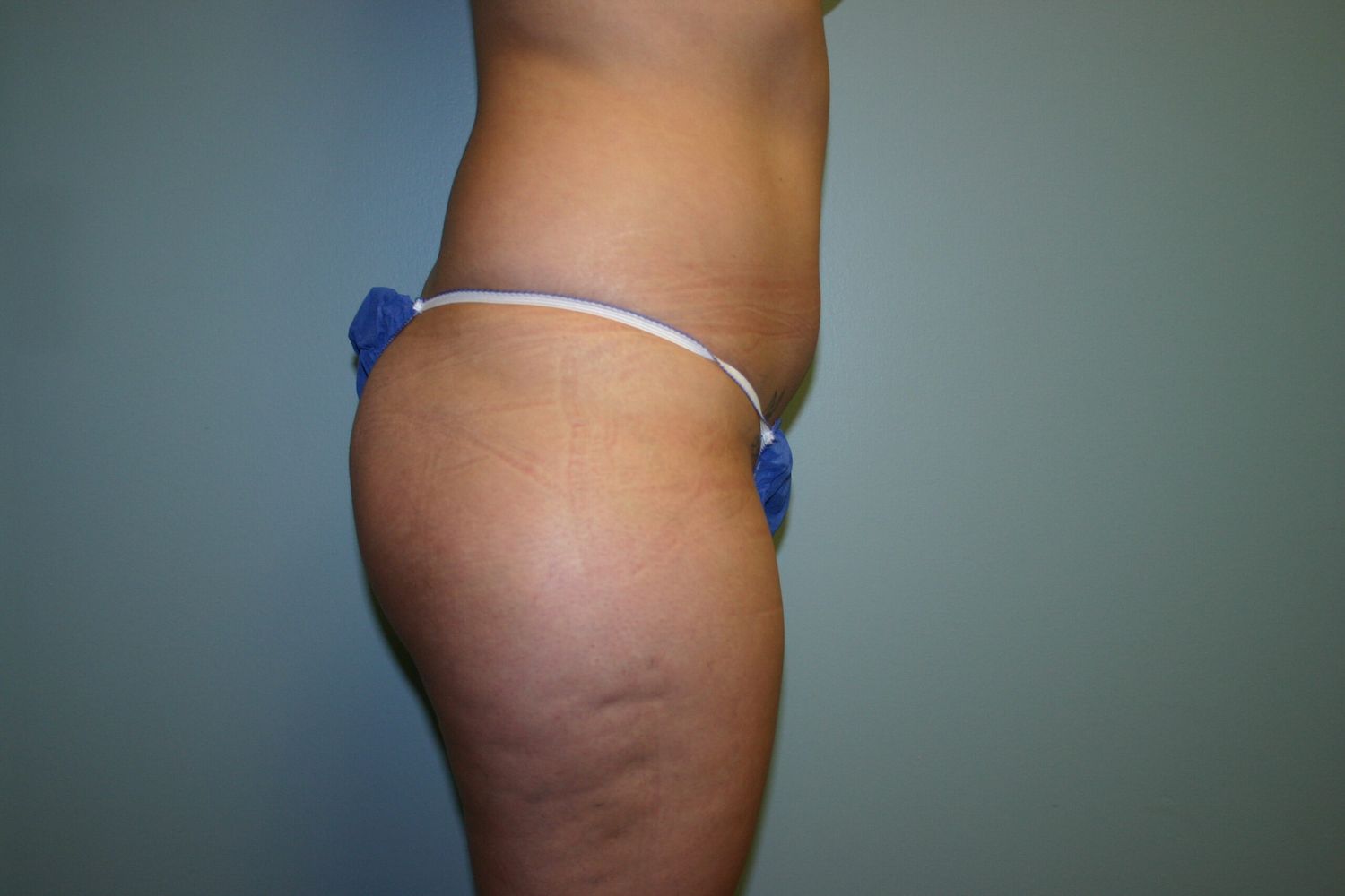 Liposuction Before & After