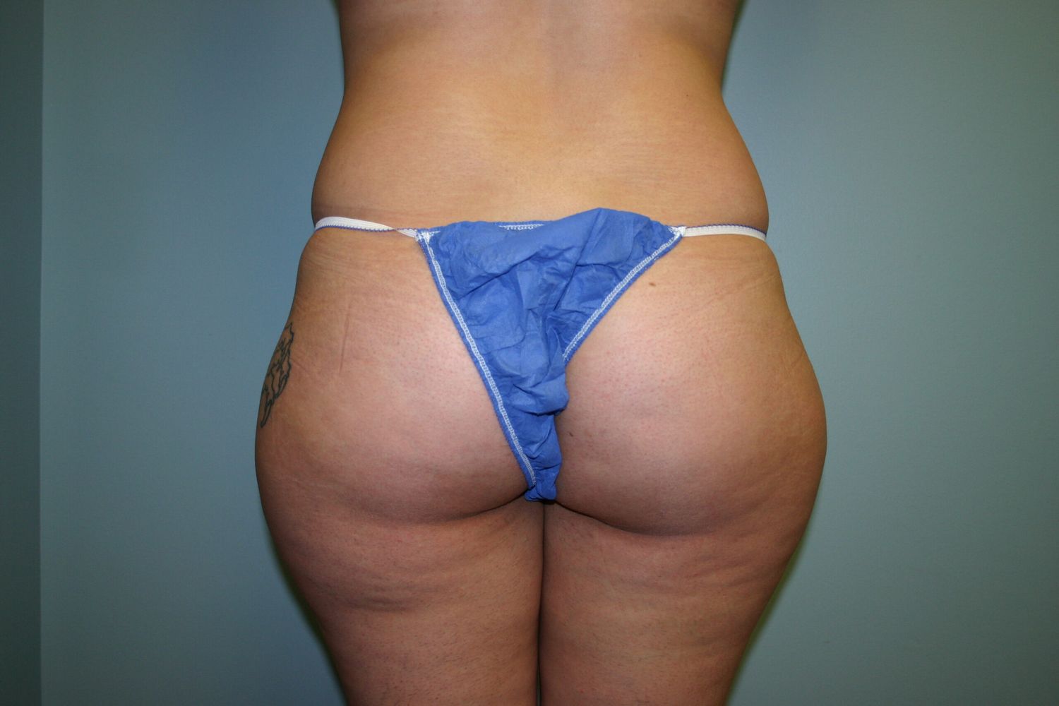 Liposuction Before & After