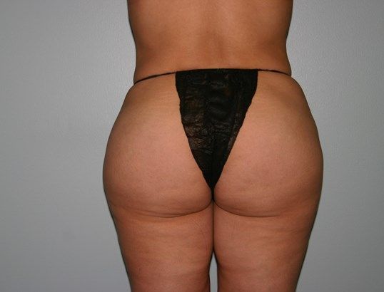 Liposuction Before & After