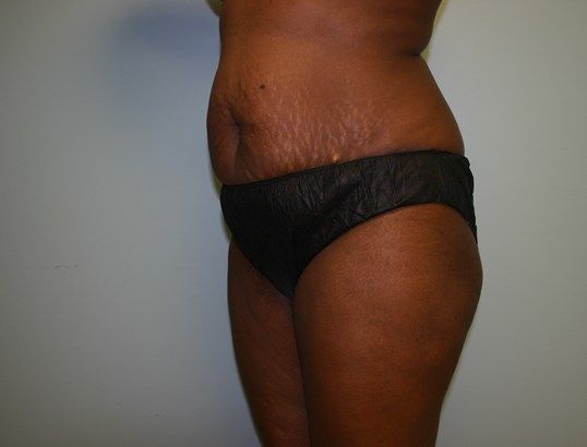 Liposuction Before & After