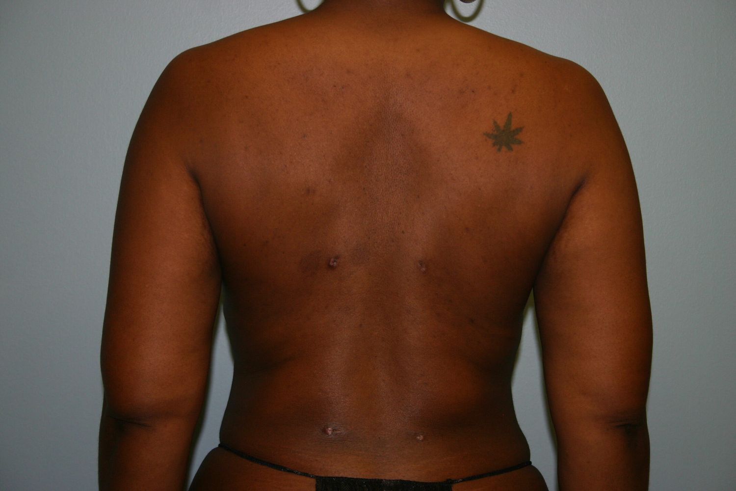 Liposuction Before & After