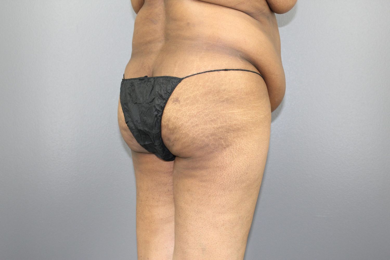 Liposuction Before & After