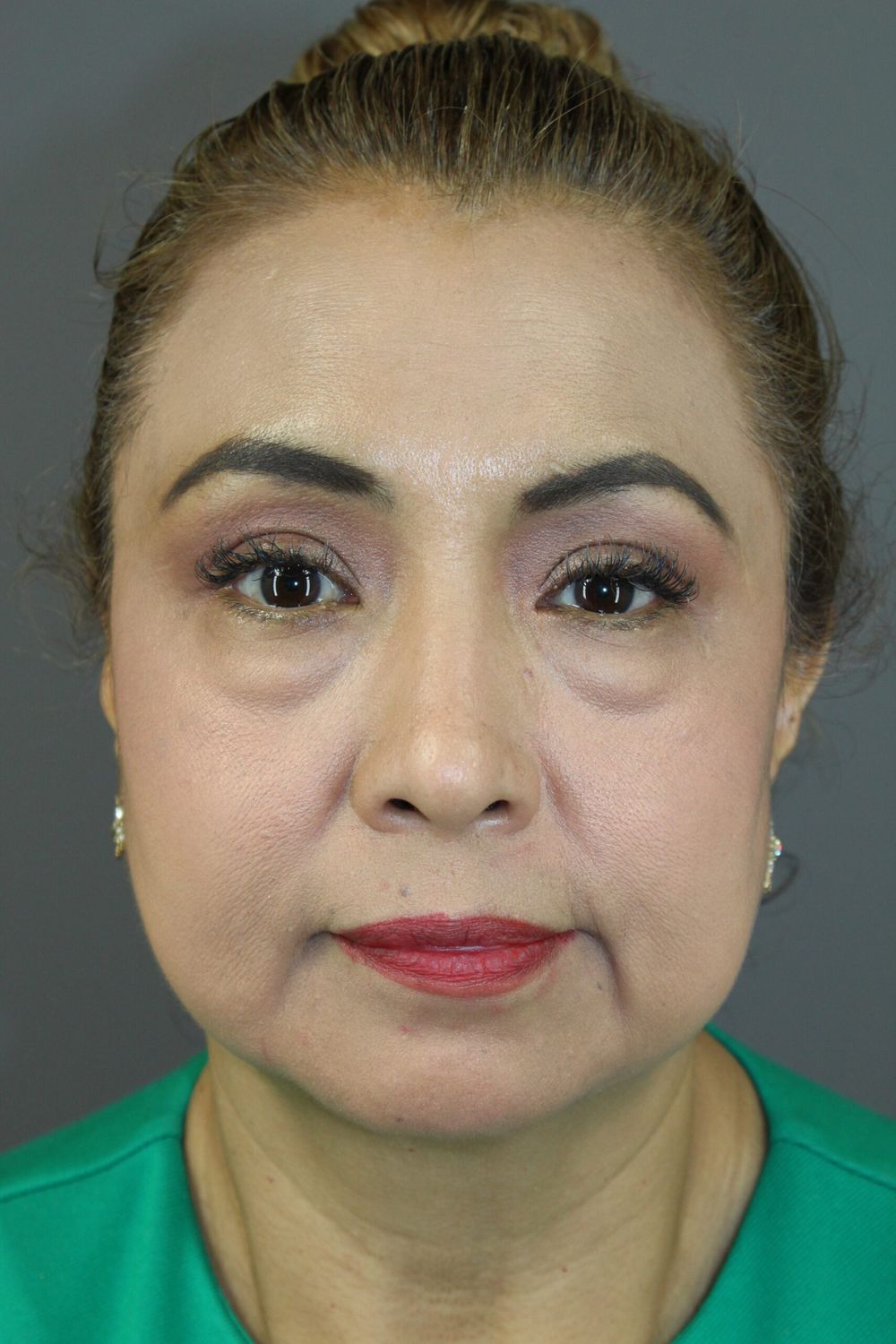 Eyelid Surgery Before & After