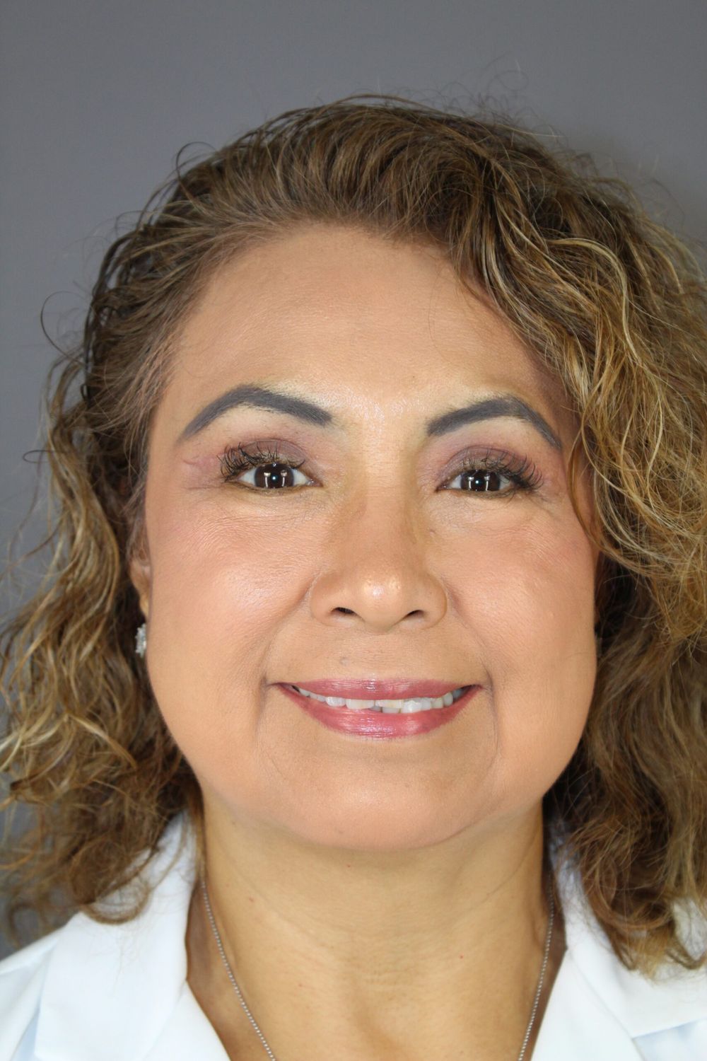 Eyelid Surgery Before & After