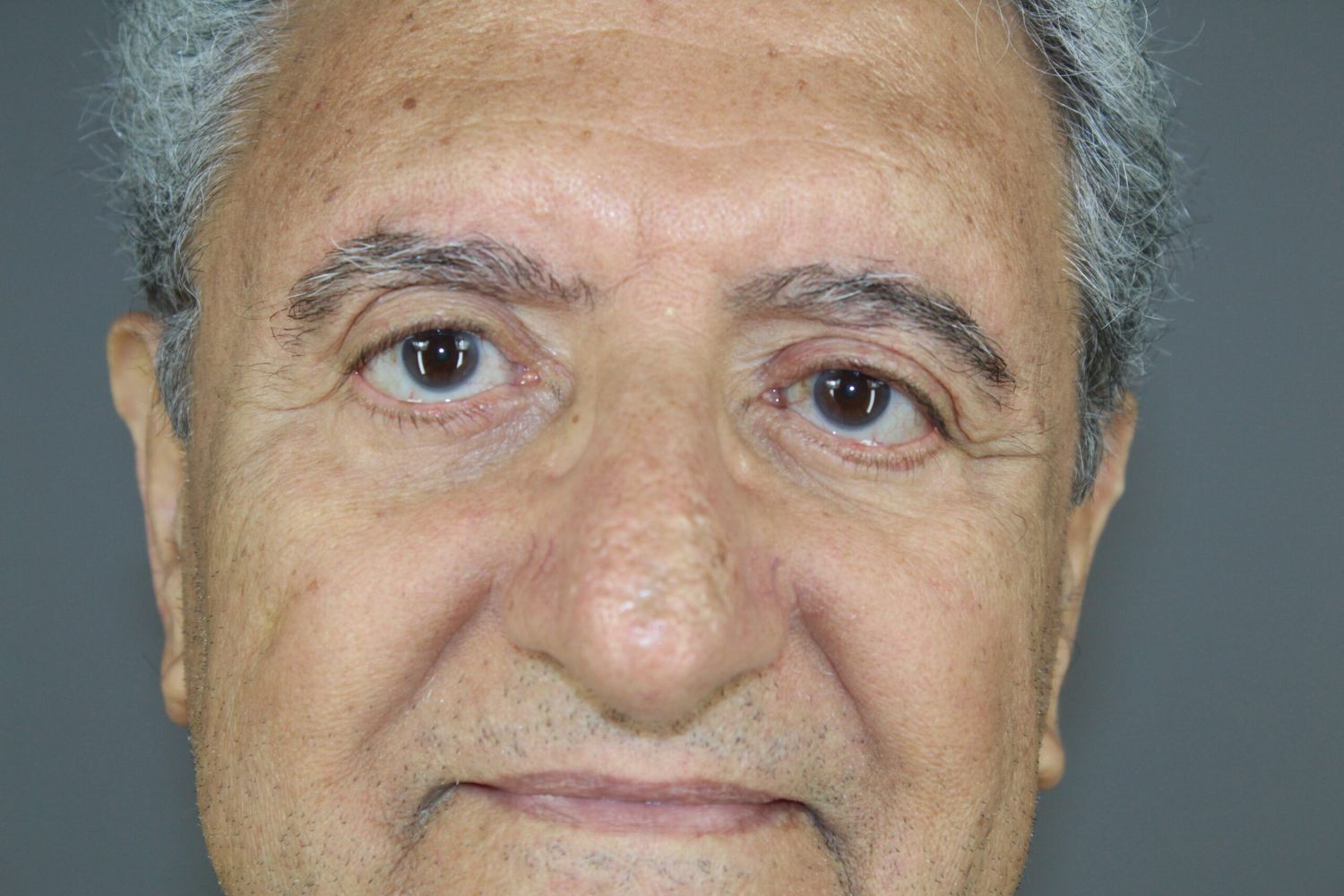 Eyelid Surgery Before & After