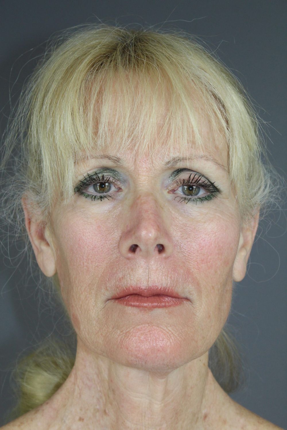 Eyelid Surgery Before & After