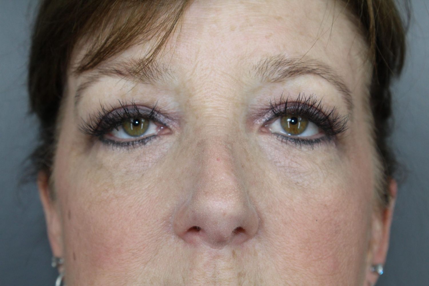Eyelid Surgery Before & After