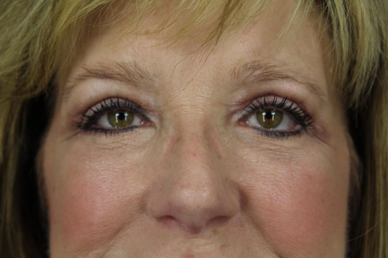 Eyelid Surgery Before & After