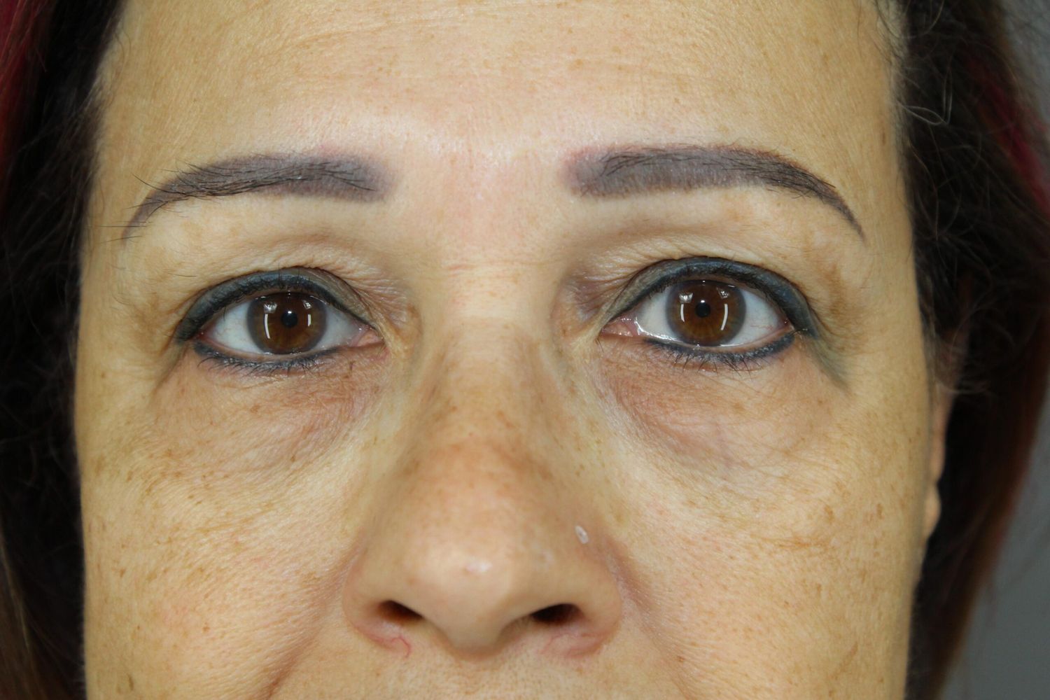 Eyelid Surgery Before & After