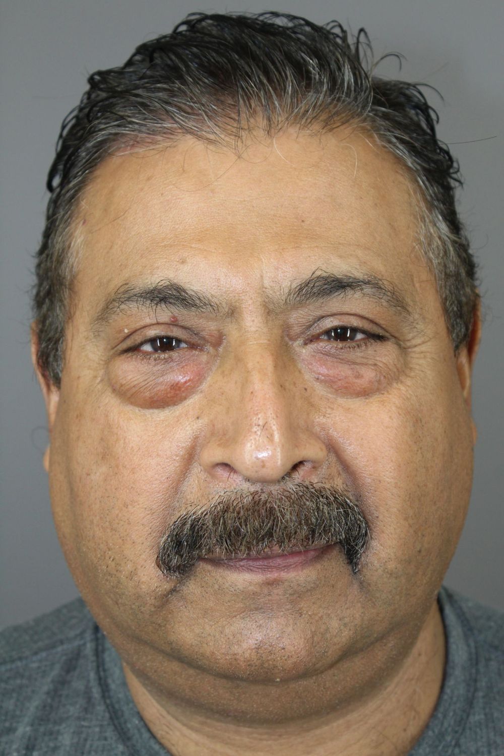 Eyelid Surgery Before & After