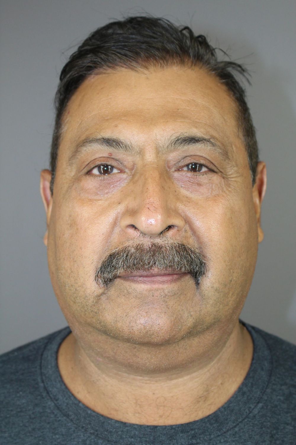 Eyelid Surgery Before & After