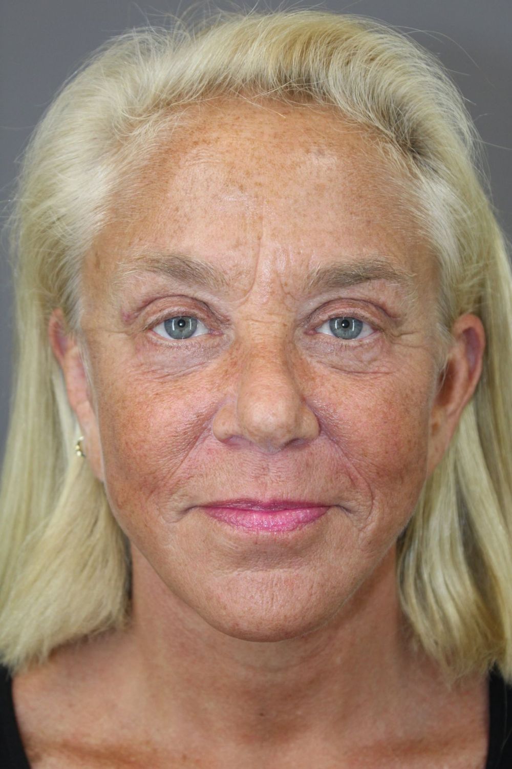 Eyelid Surgery Before & After