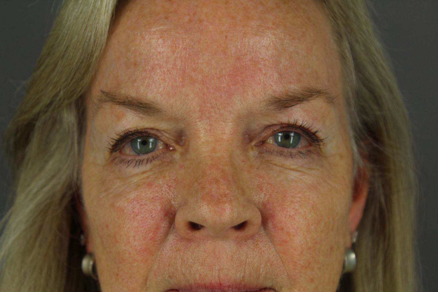 Eyelid Surgery Before & After