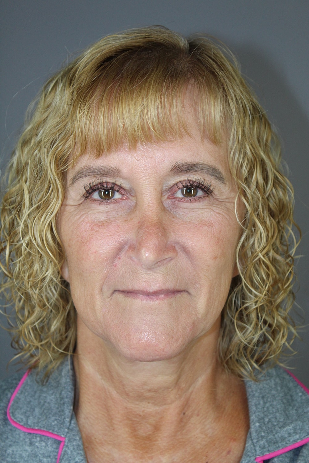 Eyelid Surgery Before & After