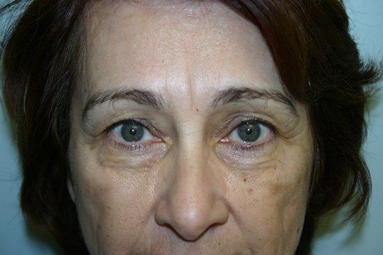 Eyelid Surgery Before & After