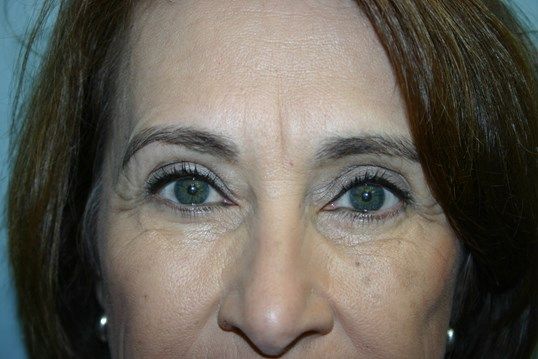Eyelid Surgery Before & After