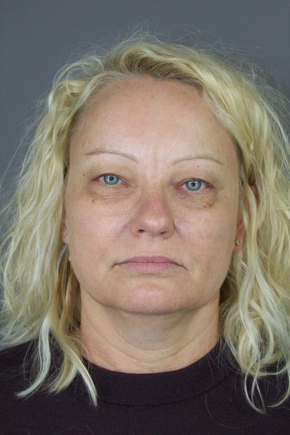 Eyelid Surgery Before & After