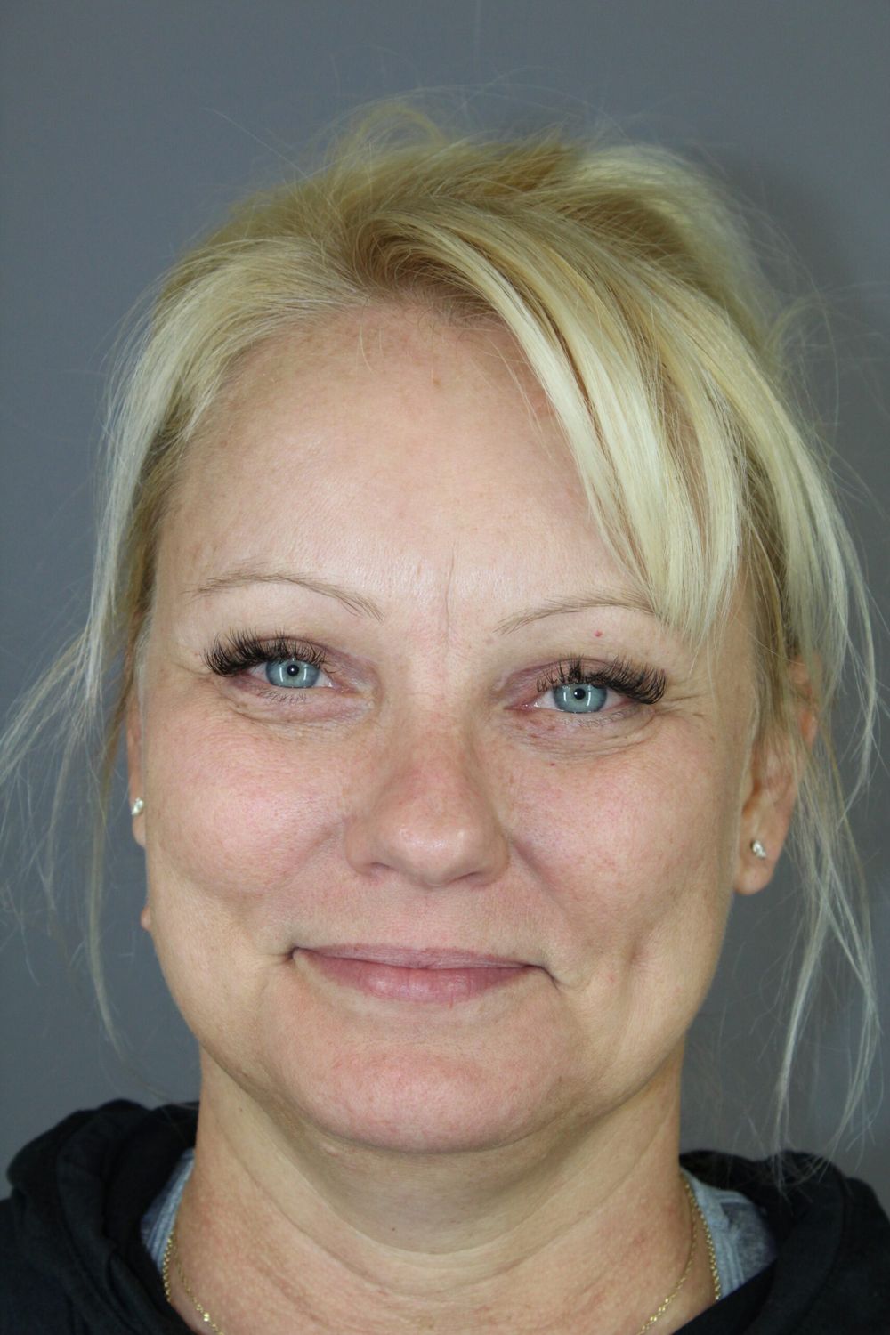 Eyelid Surgery Before & After