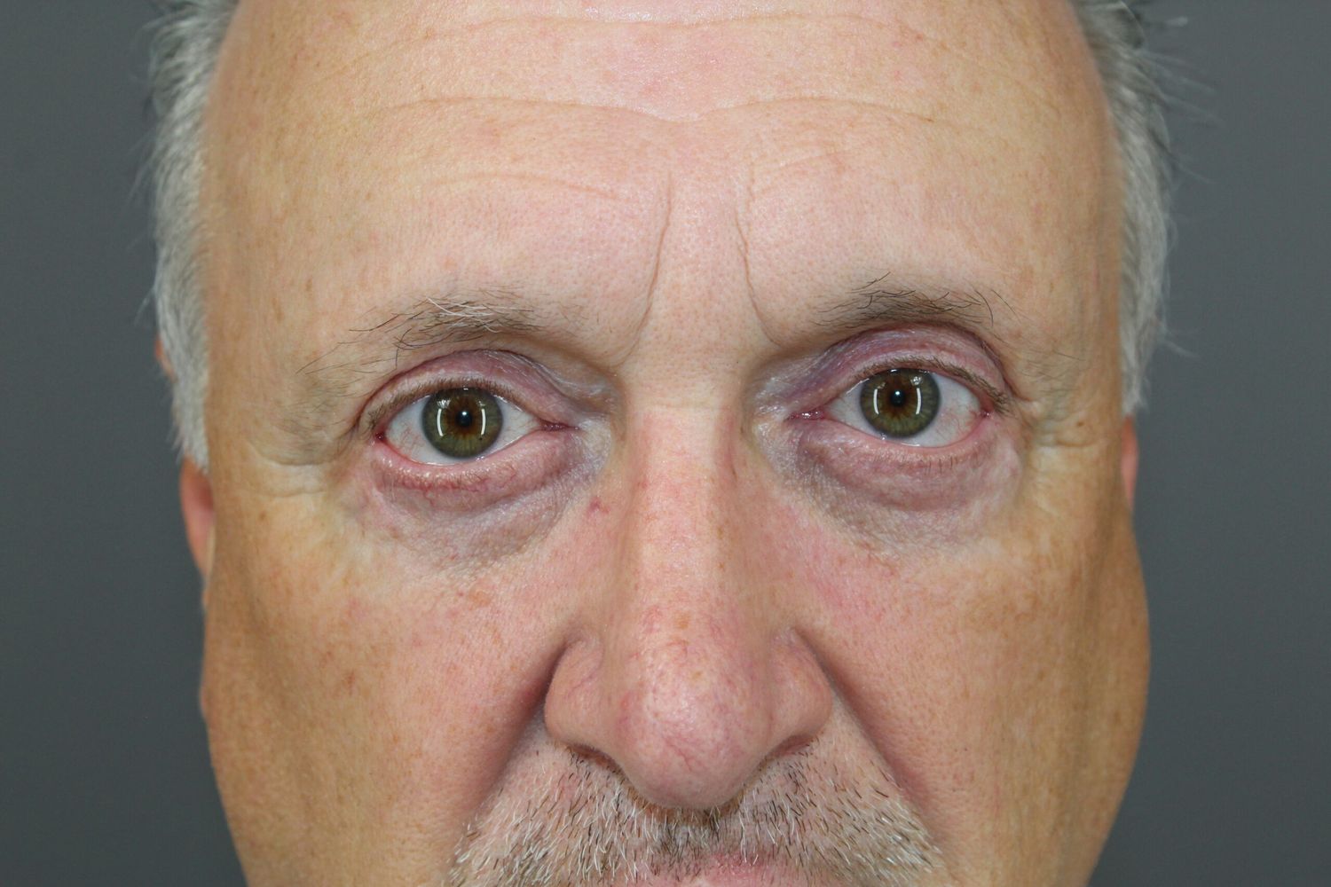 Eyelid Surgery Before & After