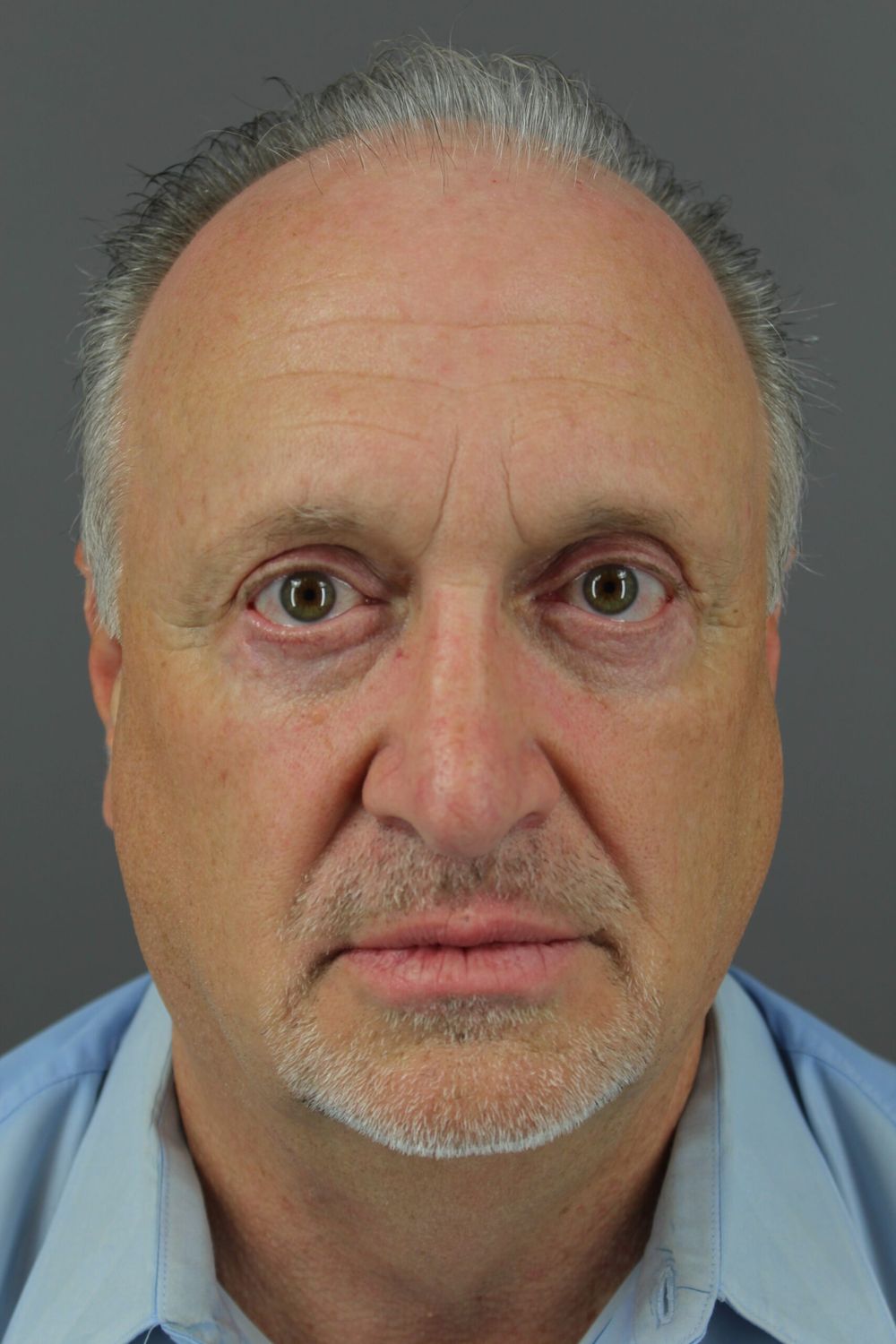 Eyelid Surgery Before & After