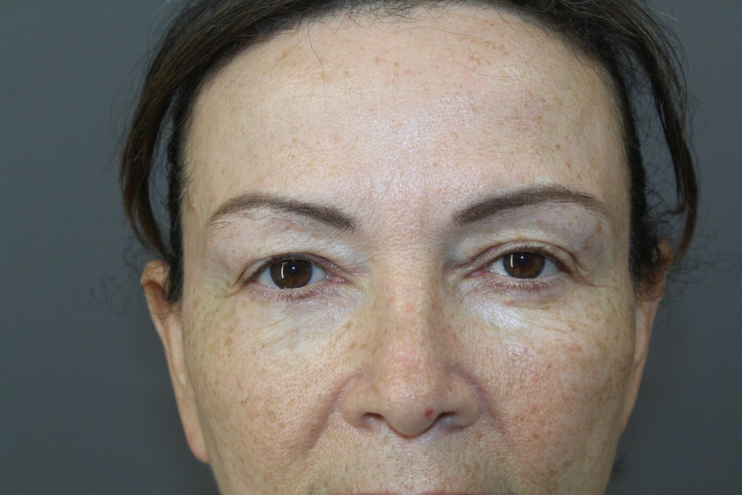 Eyelid Surgery Before & After