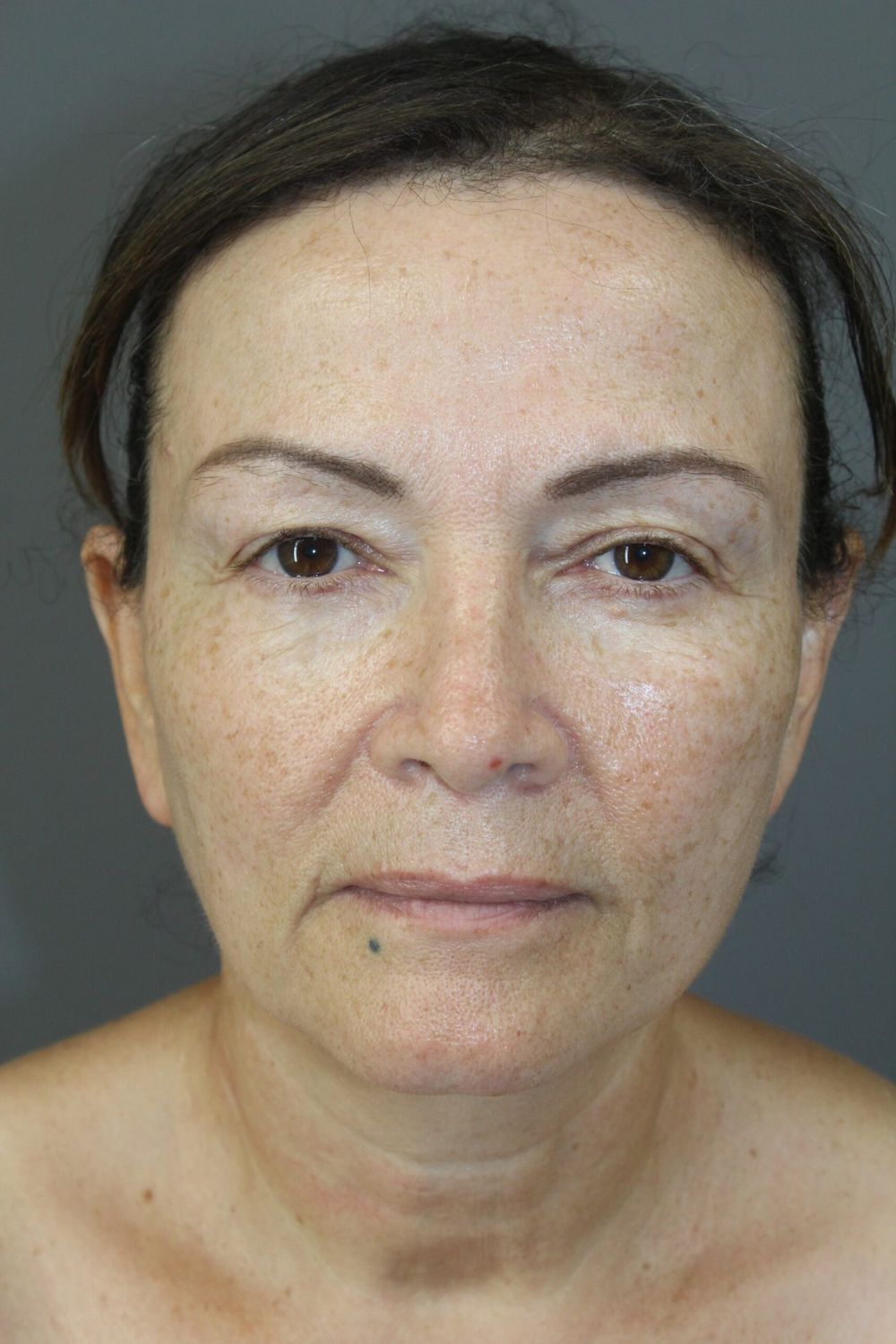 Eyelid Surgery Before & After