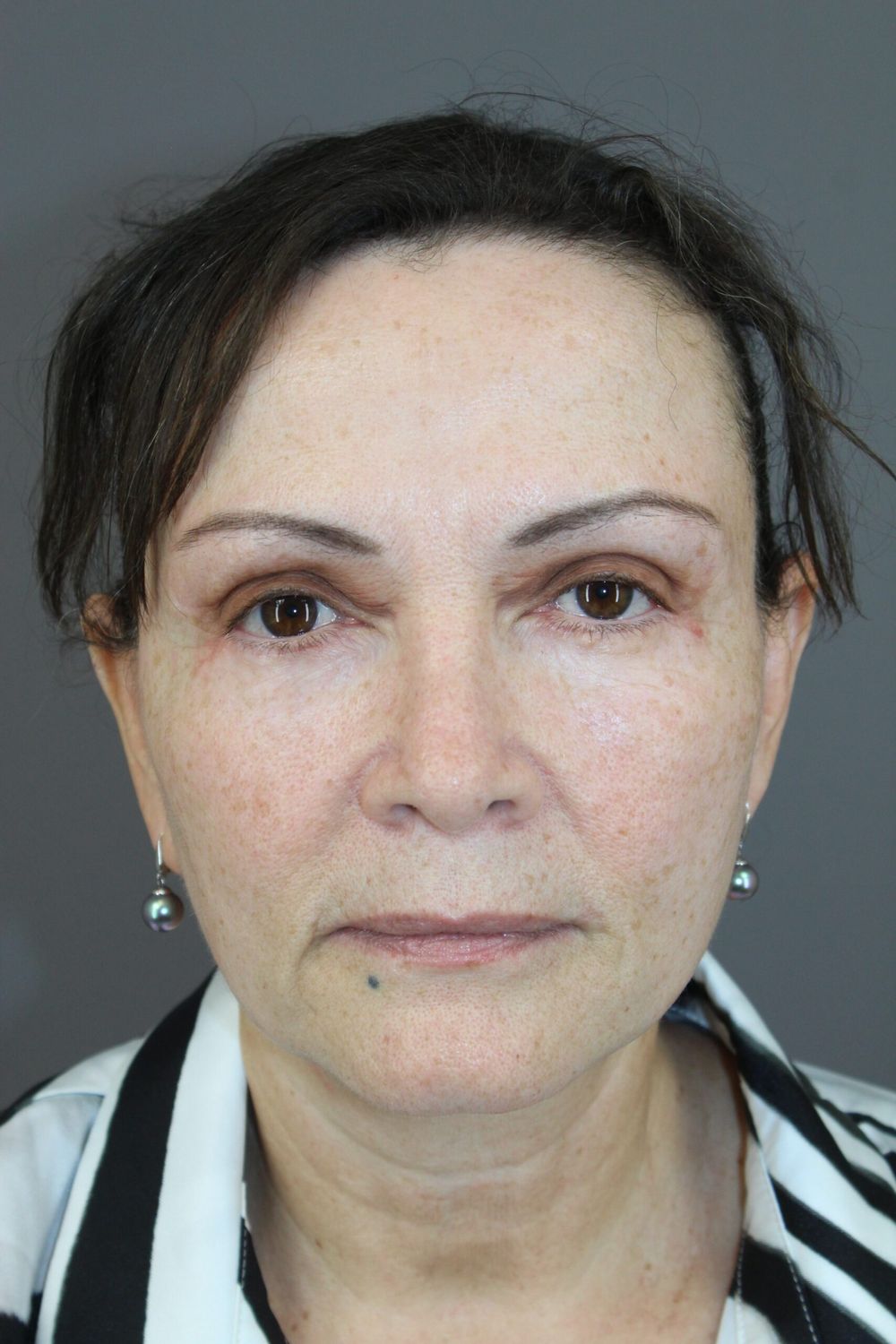 Eyelid Surgery Before & After