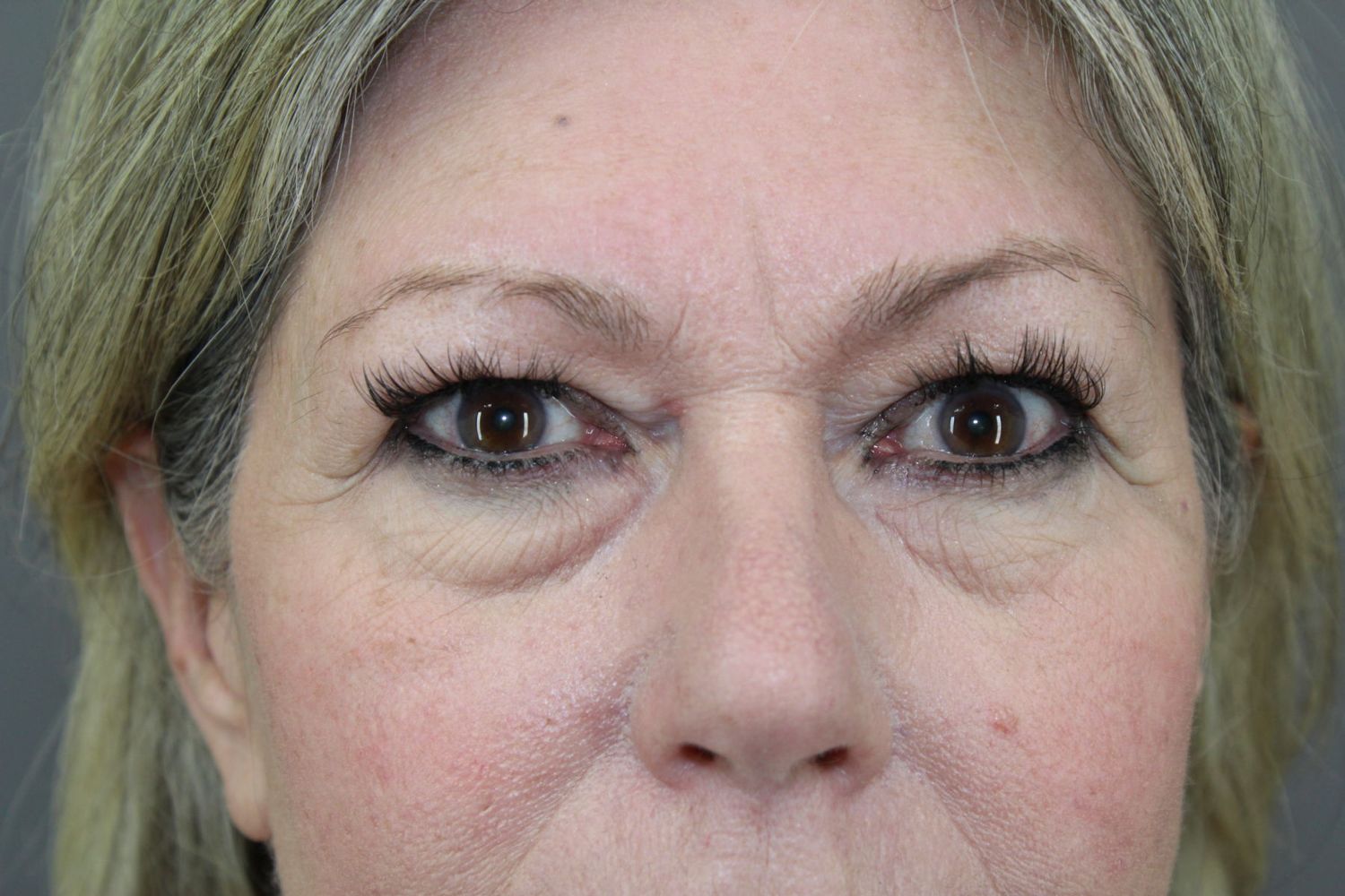 Eyelid Surgery Before & After