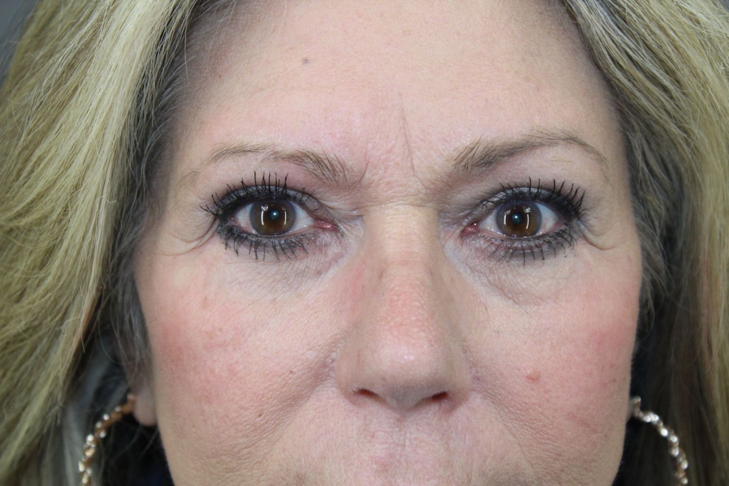 Eyelid Surgery Before & After
