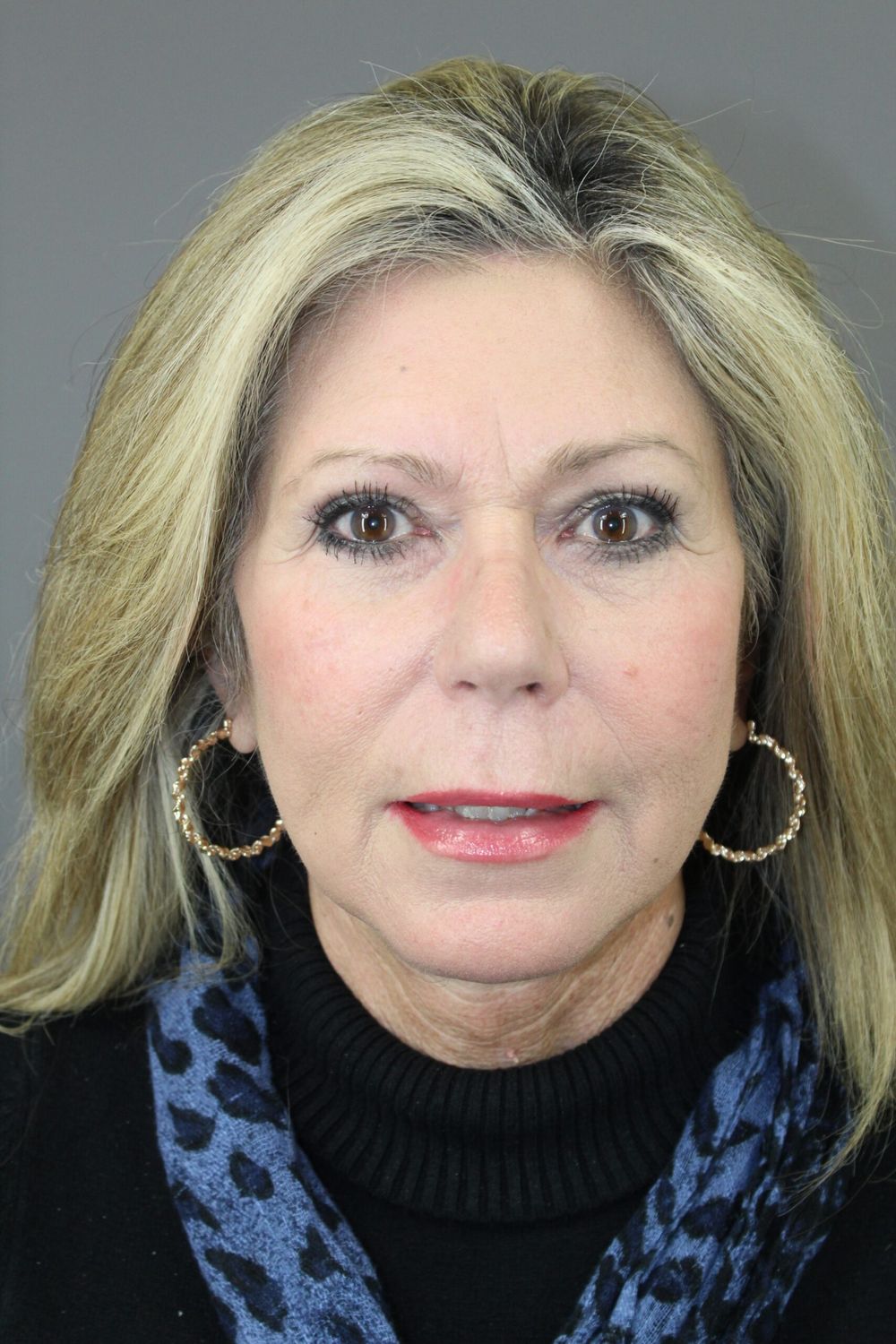 Eyelid Surgery Before & After