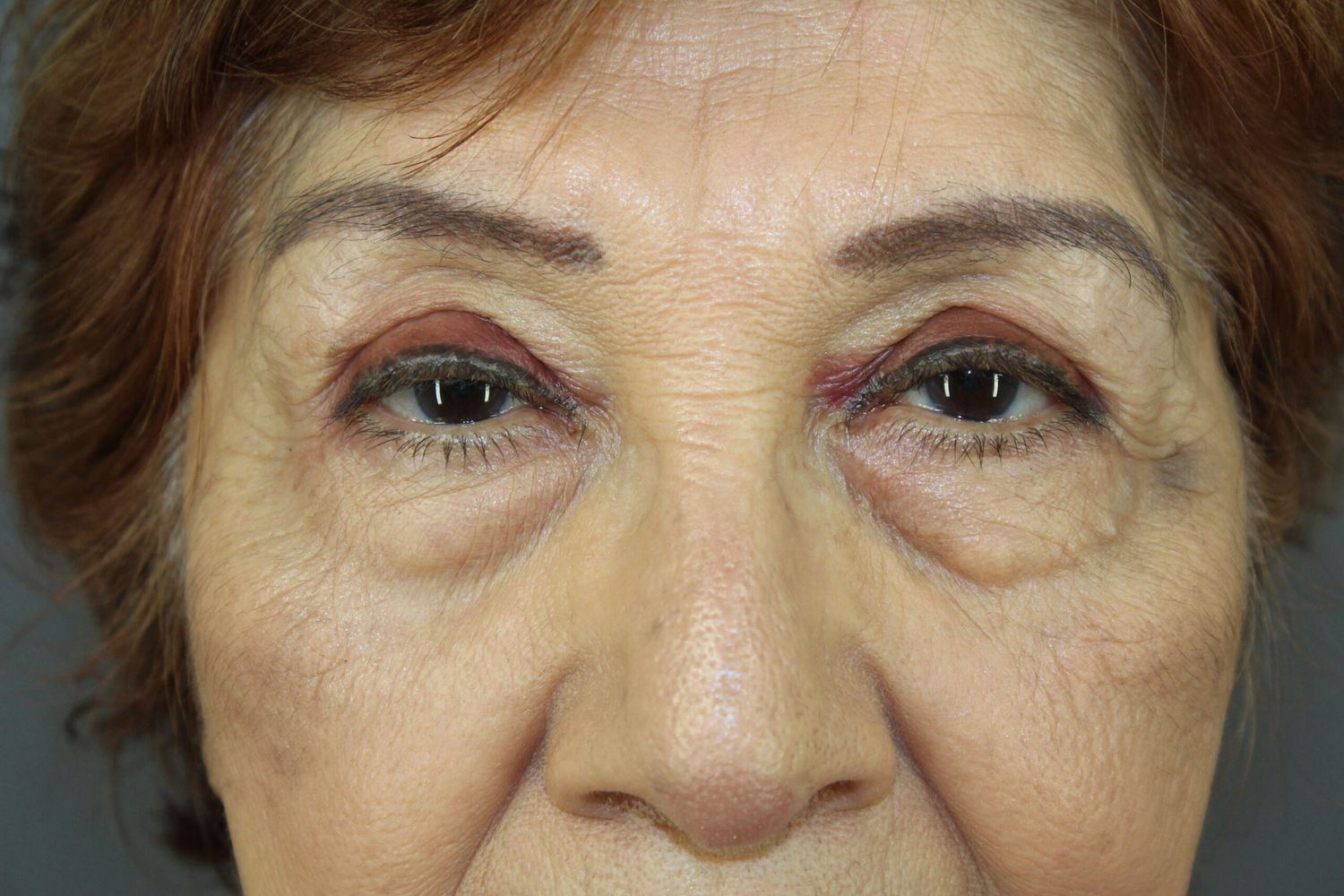 Eyelid Surgery Before & After