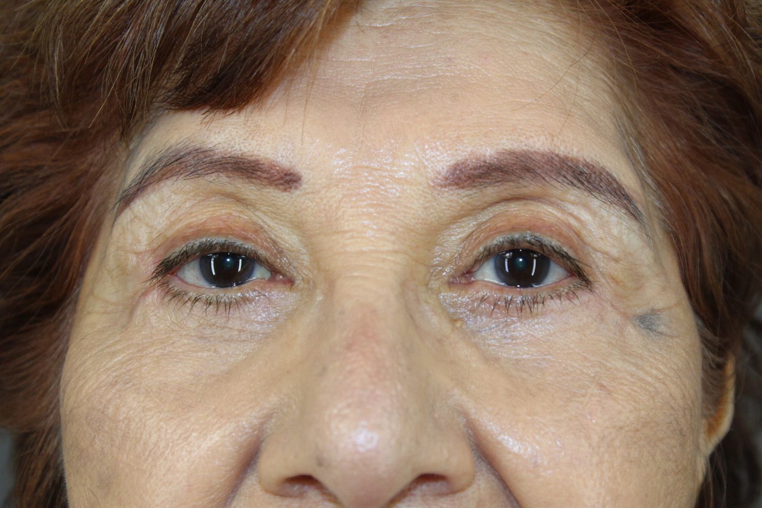 Eyelid Surgery Before & After