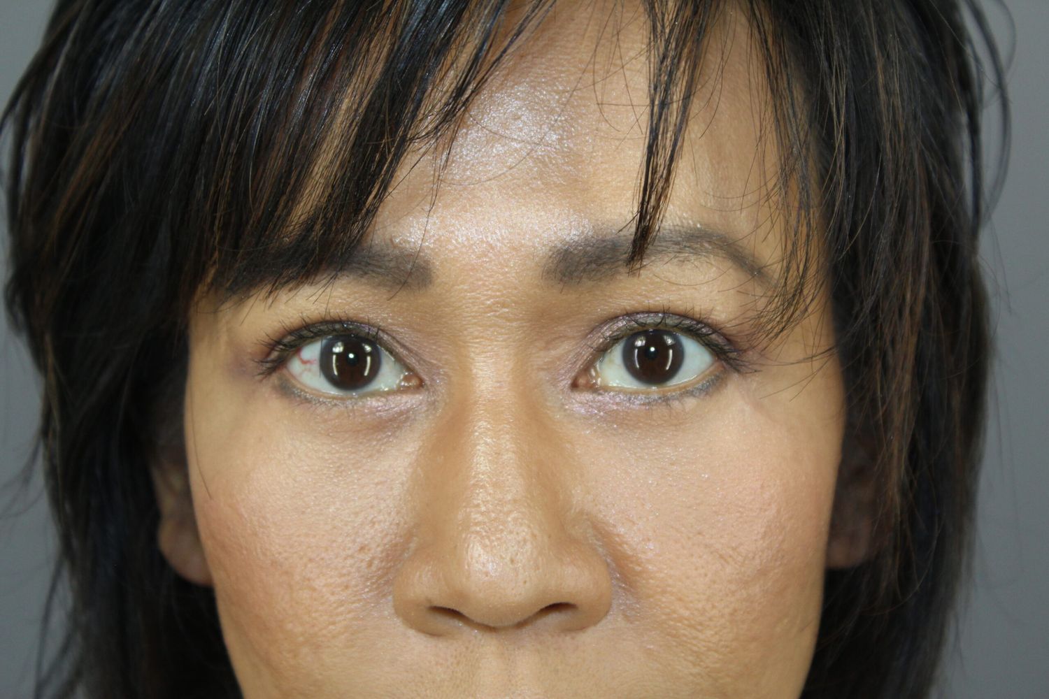 Eyelid Surgery Before & After