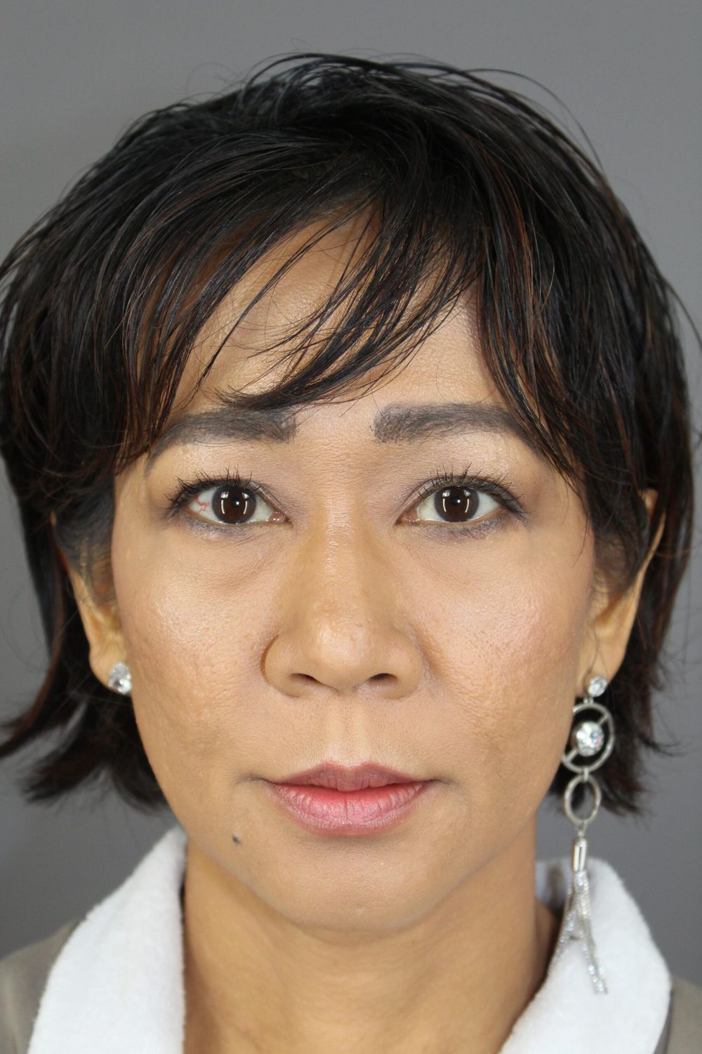 Eyelid Surgery Before & After